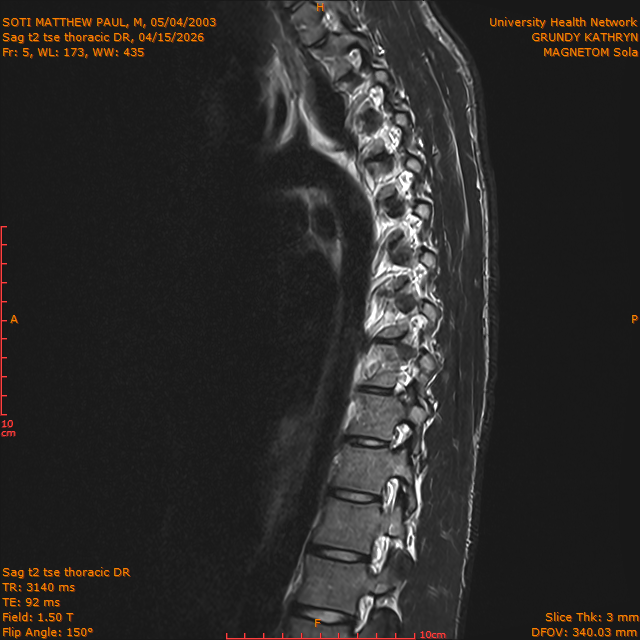 2026-04-15/Entire Spine/Sag t2 tse Thoracic DR/0006-IM309.png