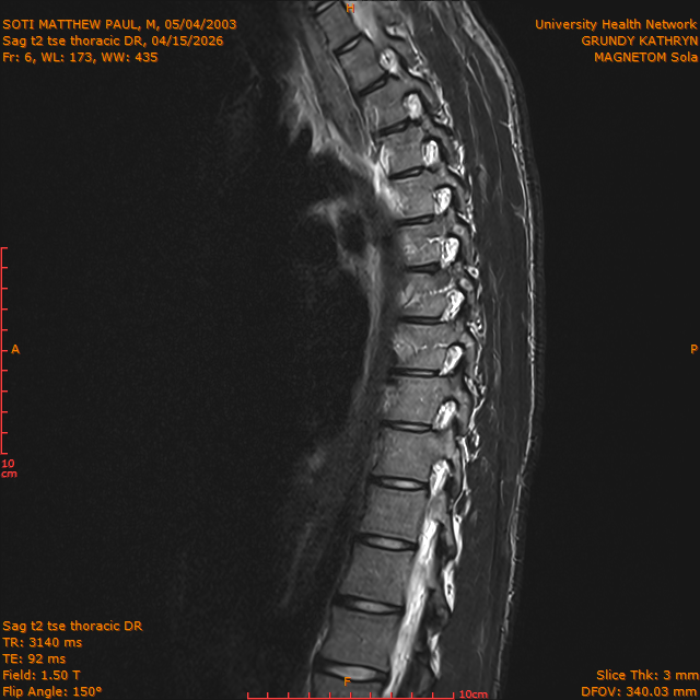2026-04-15/Entire Spine/Sag t2 tse Thoracic DR/0007-IM310.png