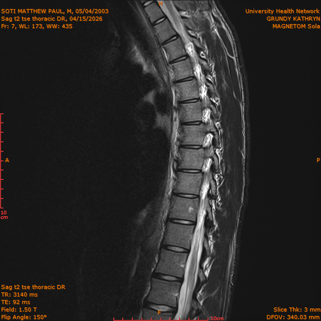 2026-04-15/Entire Spine/Sag t2 tse Thoracic DR/0008-IM311.png