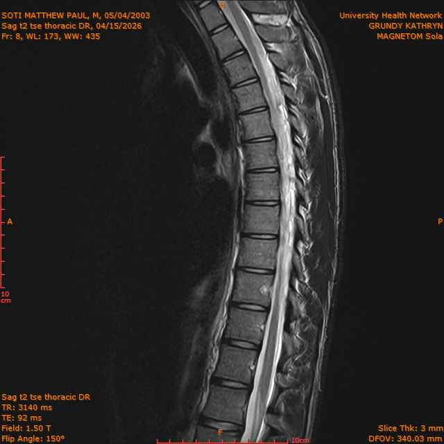2026-04-15/Entire Spine/Sag t2 tse Thoracic DR/0009-IM312.png