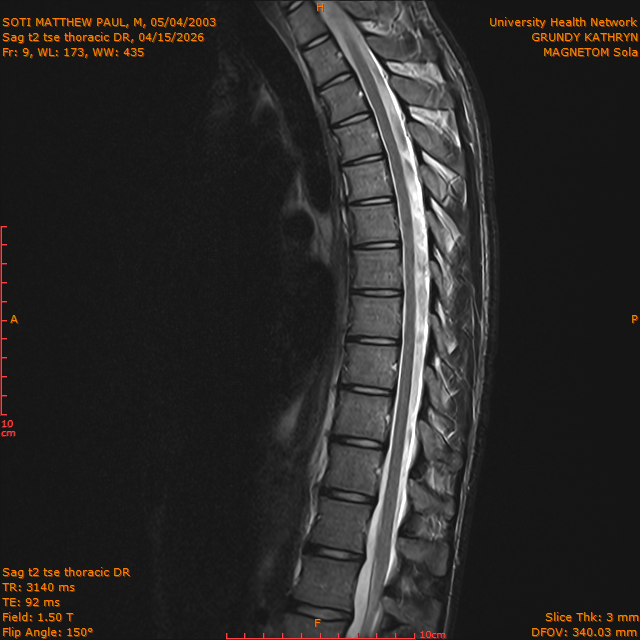 2026-04-15/Entire Spine/Sag t2 tse Thoracic DR/0010-IM313.png
