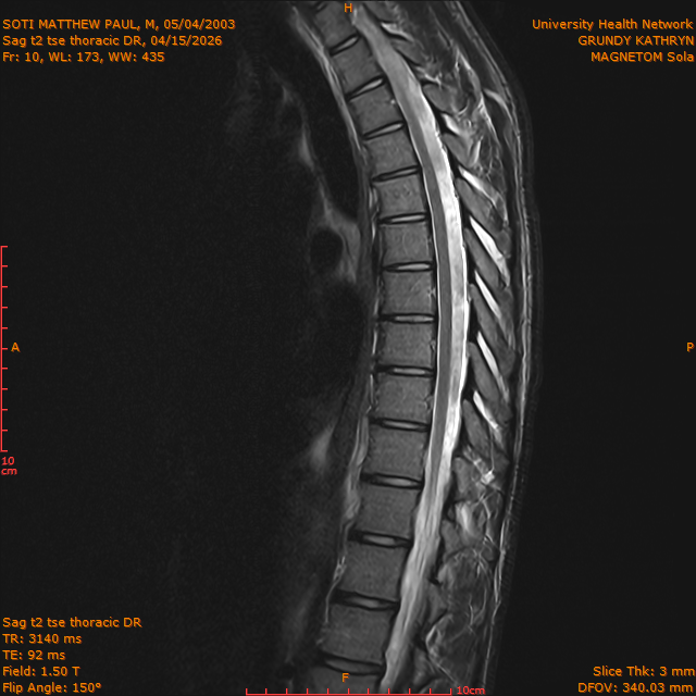 2026-04-15/Entire Spine/Sag t2 tse Thoracic DR/0011-IM314.png