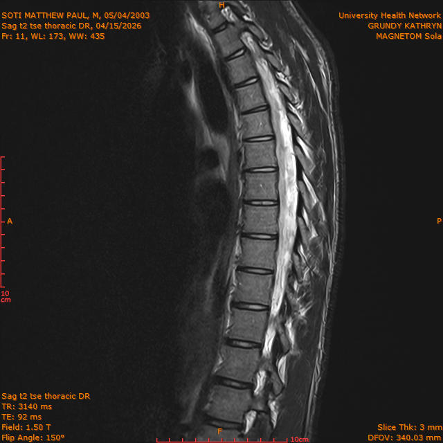 2026-04-15/Entire Spine/Sag t2 tse Thoracic DR/0012-IM315.png