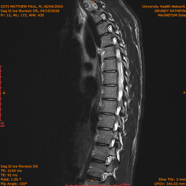 2026-04-15/Entire Spine/Sag t2 tse Thoracic DR/0013-IM316.png