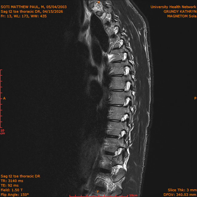 2026-04-15/Entire Spine/Sag t2 tse Thoracic DR/0014-IM317.png