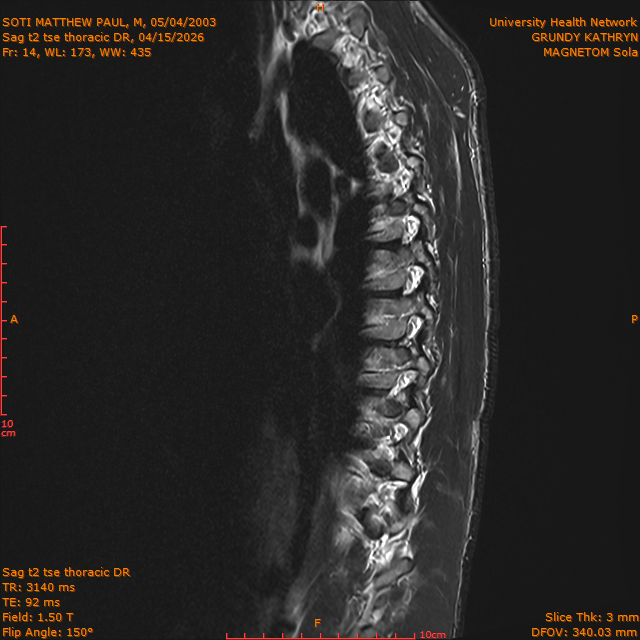 2026-04-15/Entire Spine/Sag t2 tse Thoracic DR/0015-IM318.png