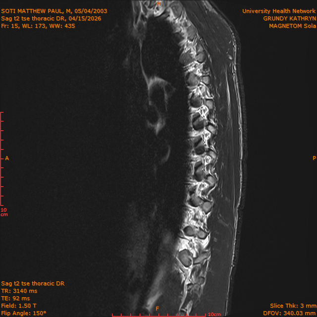 2026-04-15/Entire Spine/Sag t2 tse Thoracic DR/0016-IM319.png