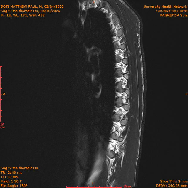 2026-04-15/Entire Spine/Sag t2 tse Thoracic DR/0017-IM320.png