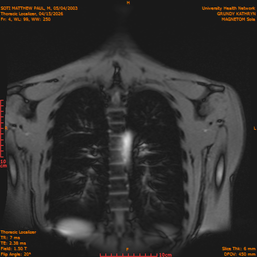 2026-04-15/Entire Spine/Thoracic Localizer/0005-IM152.png