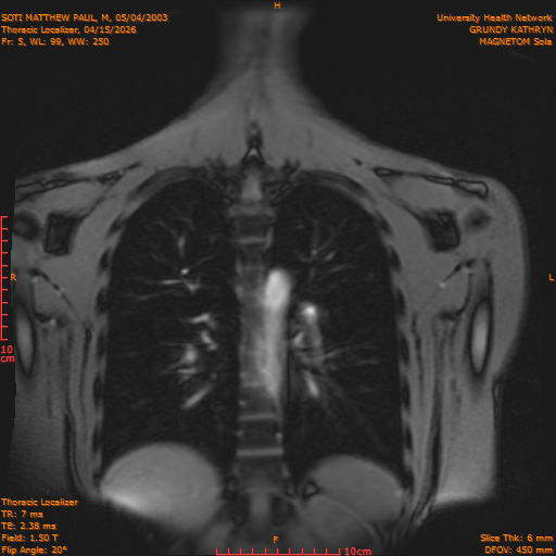 2026-04-15/Entire Spine/Thoracic Localizer/0006-IM153.png