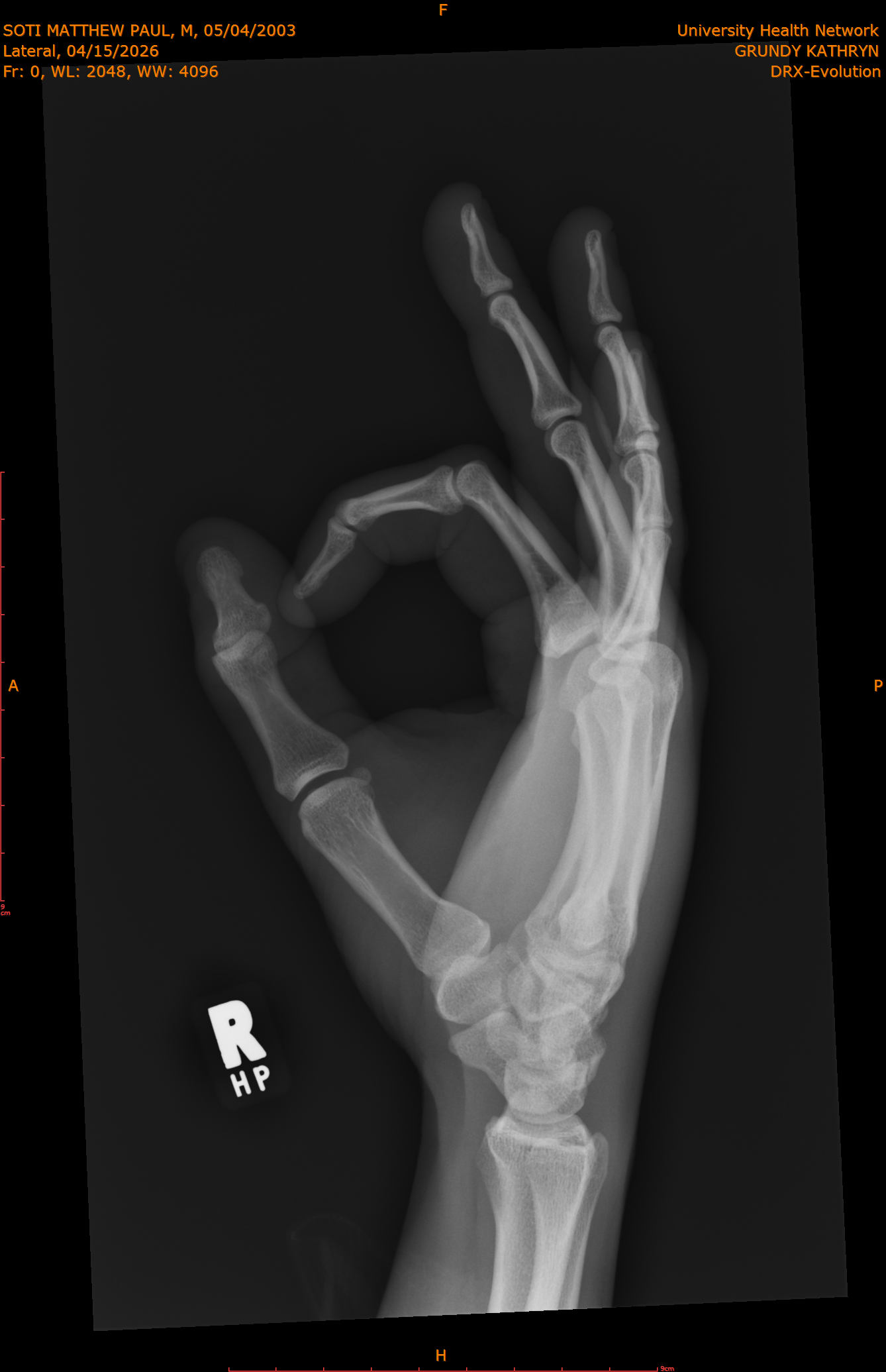 2026-04-15/Right Hand/Lateral/0001-.png