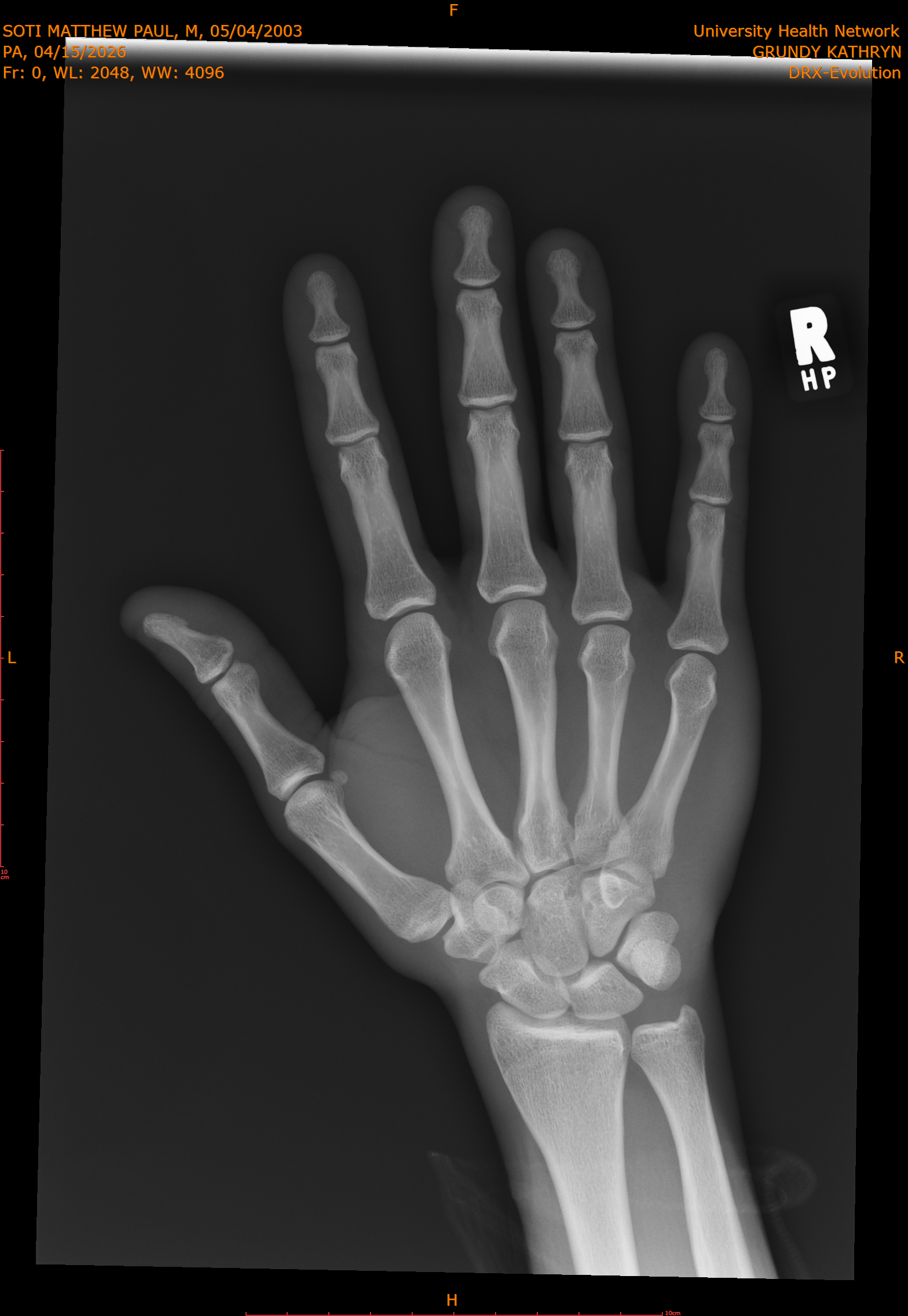 2026-04-15/Right Hand/PA/0001-.png